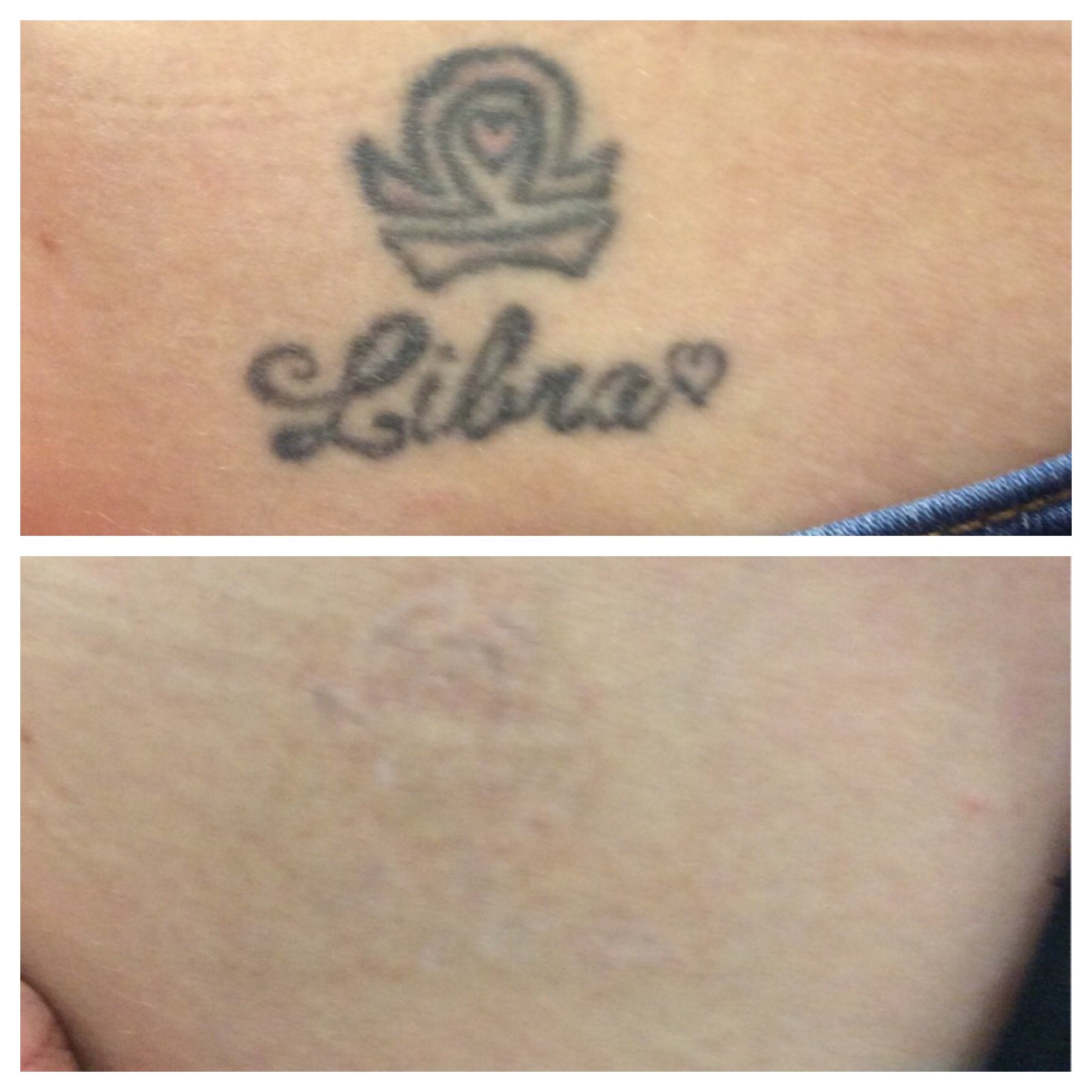 Before and after top and bottom of tattoo removal of a Libra tattoo