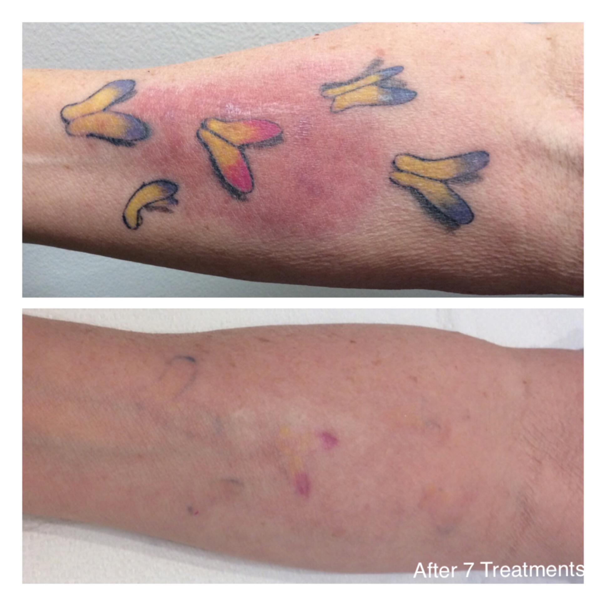 Before and after top and bottom of tattoo removal for butterflies tattoo on someone's inner forearm