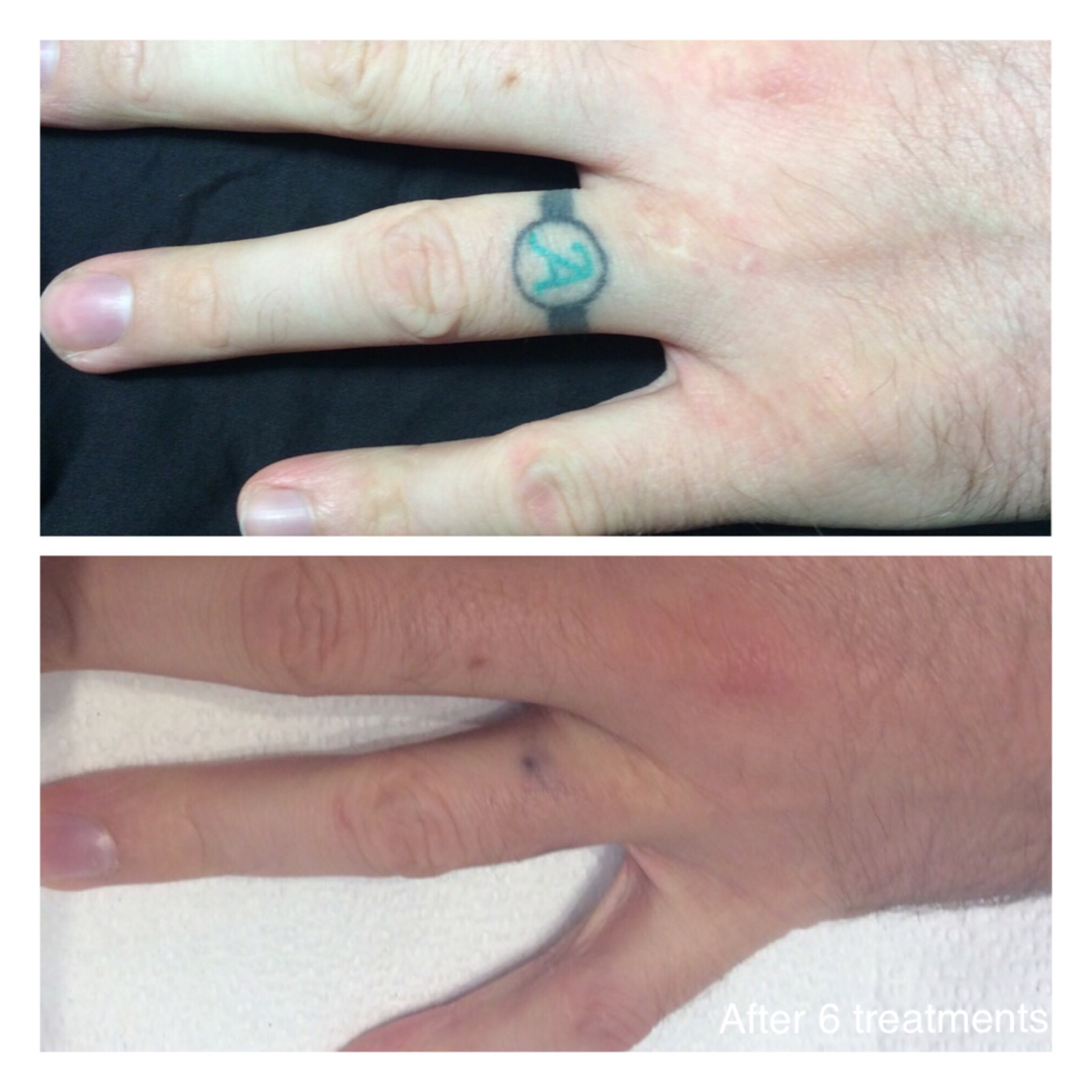 Before and after top and bottom of tattoo removal for a ring tattoo on someone's finger