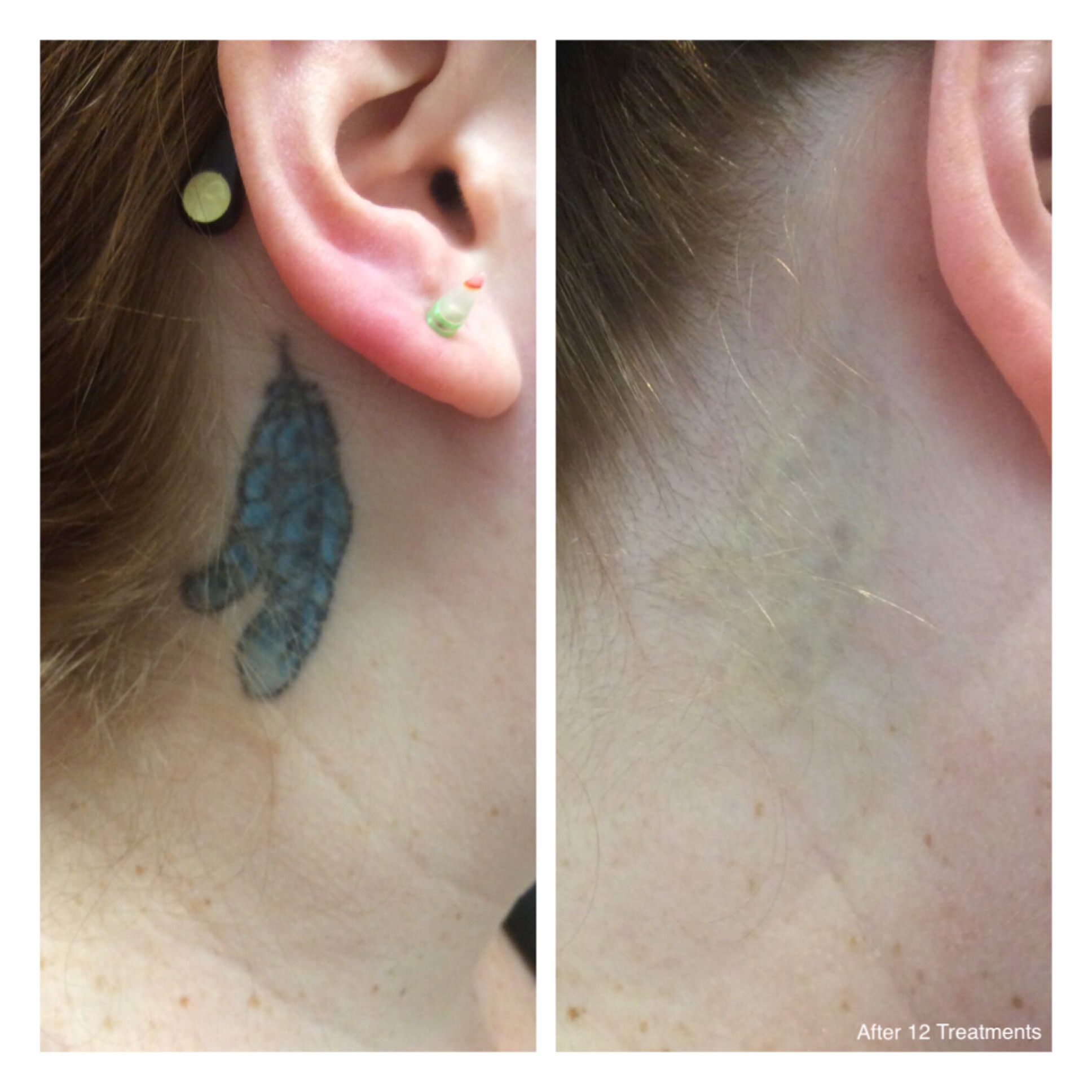 Before and after side by side of tattoo removal of blue feathers behind a woman's ear
