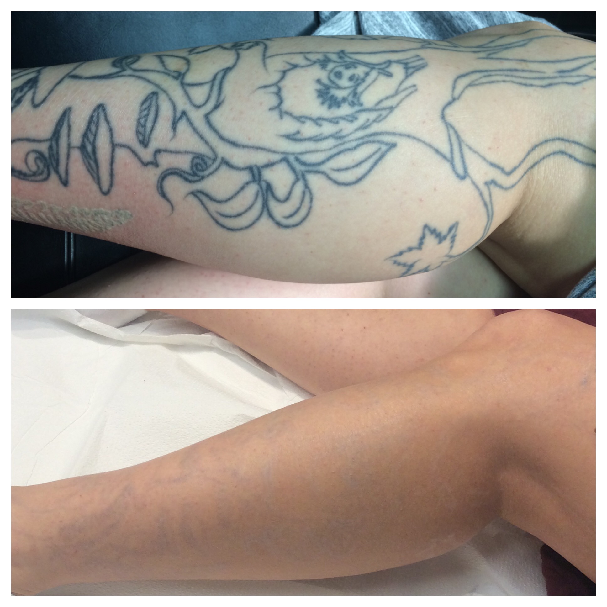 Before and after top and bottom comparison of tattoo removal for a tree tattoo on someone's calf