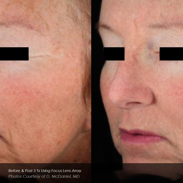 Before and after side by side comparison of wrinkle reduction on an older woman with eyes hidden