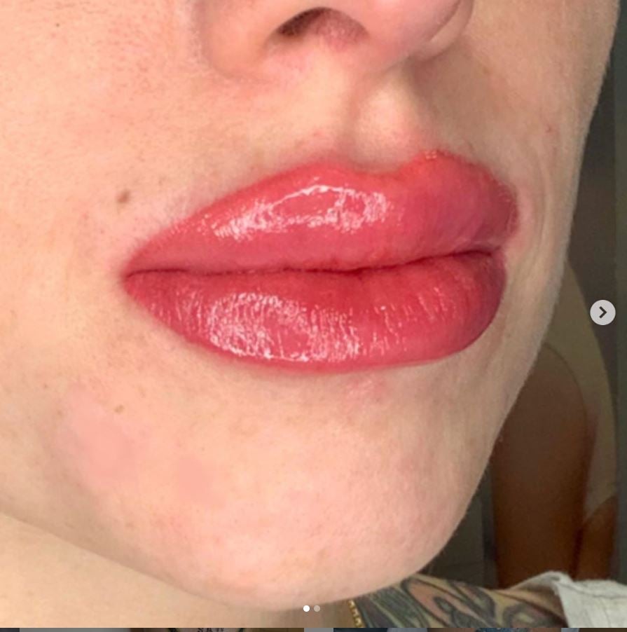 Screenshot of closeup of woman's lips after lip procedure