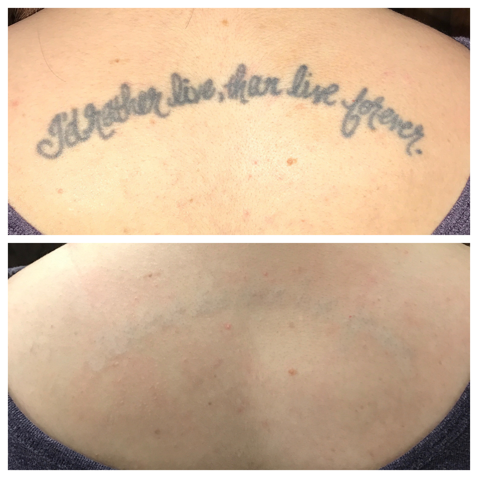Before and after top and bottom of tattoo removal of one of the worst tattoos ever reading 