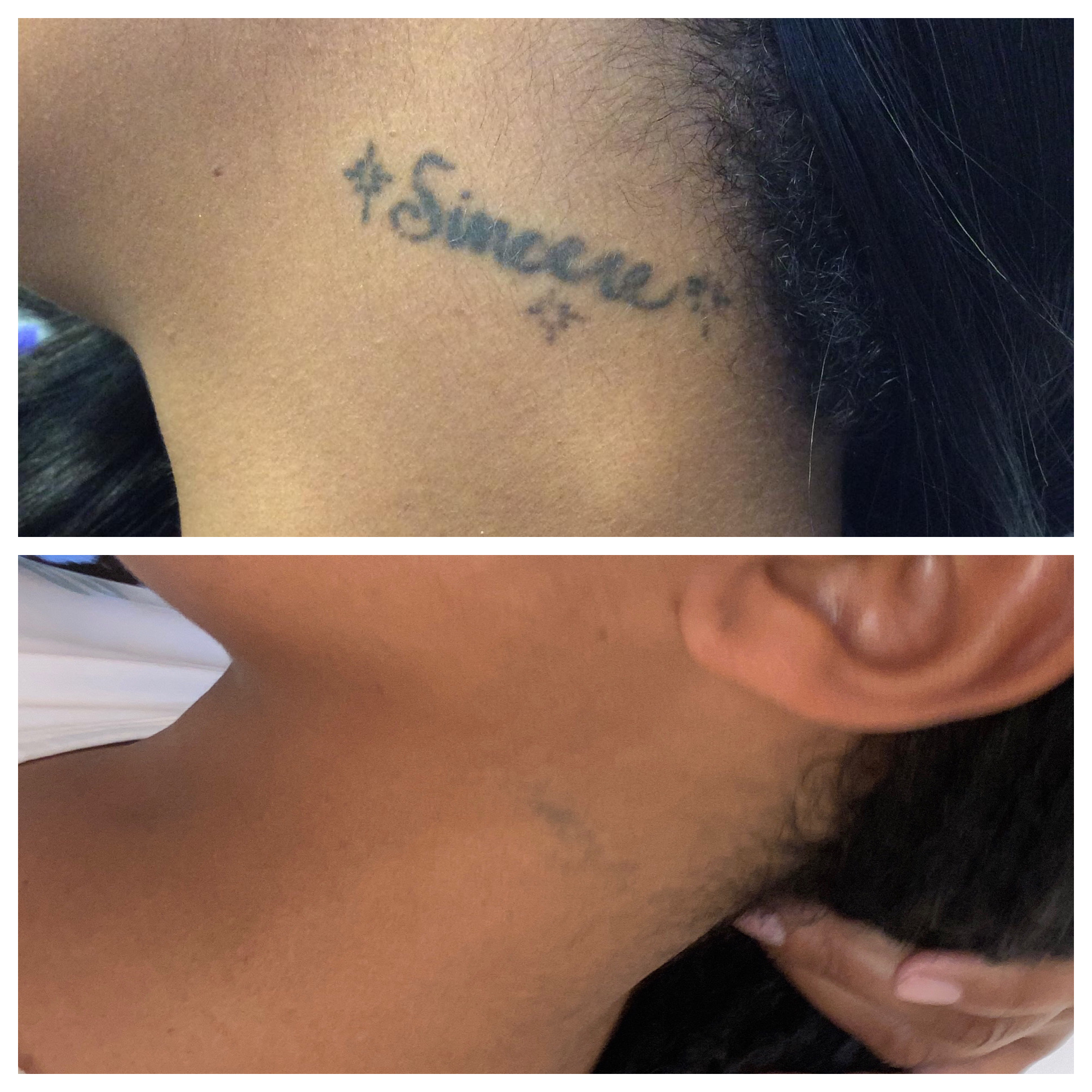Before and after top and bottom of tattoo removal of word 